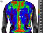 Osteochondrosis