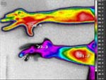 Blood circulation recovering after reimplantation 