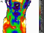 Hypofunction of thyroid gland