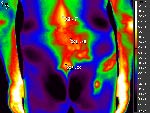 Radicular syndrome