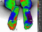 Diabetic foot
