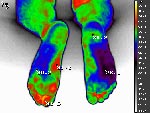 Diabetic foot